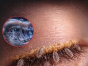 চোখের মাইট: আতঙ্ক নয়, বৈজ্ঞানিক সত্য কী বলছে গবেষণা? মানুষের চোখের পাপড়ির লোমকূপে থাকা অতি ক্ষুদ্র ডেমোডেক্স মাইটের বৈজ্ঞানিক উপস্থাপন।