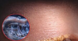 মানুষের চোখের পাপড়ির লোমকূপে থাকা অতি ক্ষুদ্র ডেমোডেক্স মাইটের বৈজ্ঞানিক উপস্থাপন।