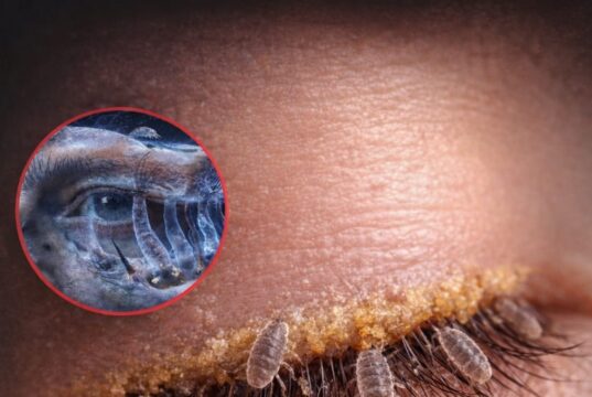 মানুষের চোখের পাপড়ির লোমকূপে থাকা অতি ক্ষুদ্র ডেমোডেক্স মাইটের বৈজ্ঞানিক উপস্থাপন।